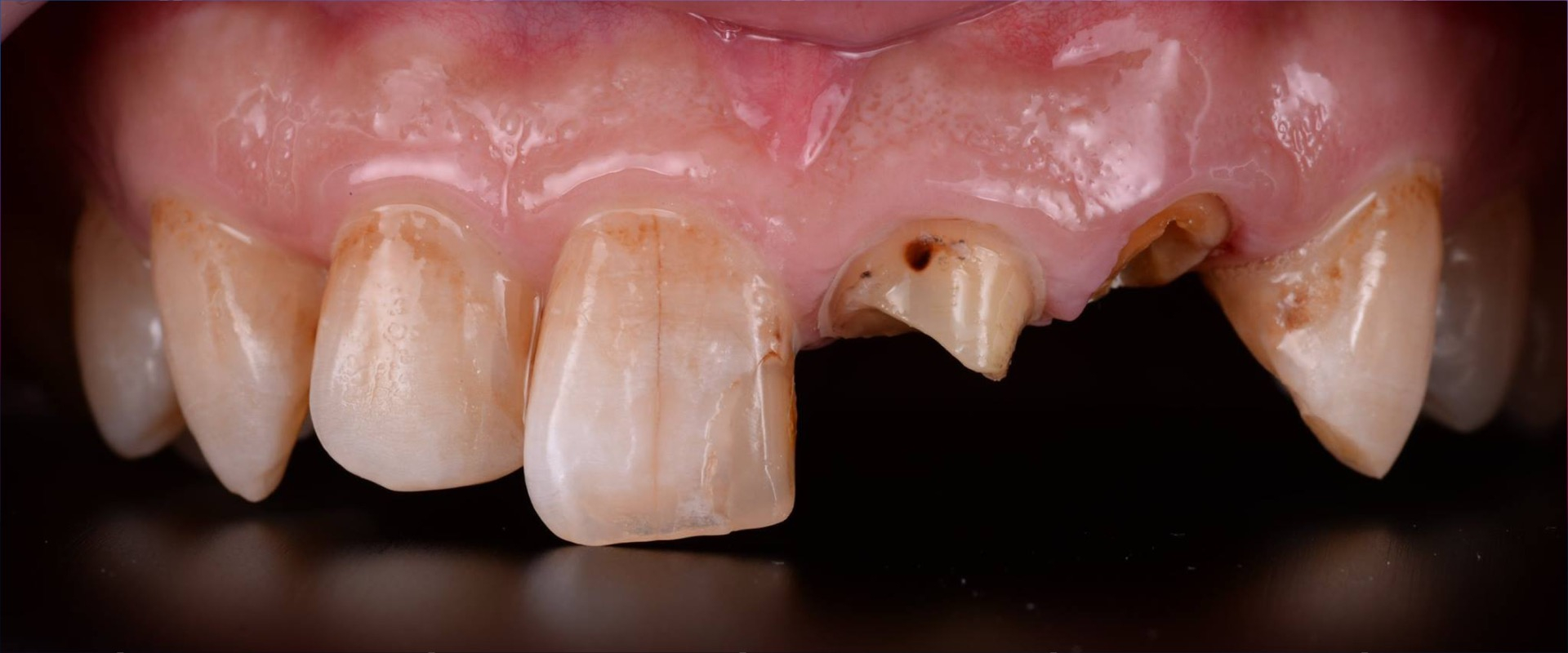 Extrusions-Therapie mit Wurzelstiftversorgung