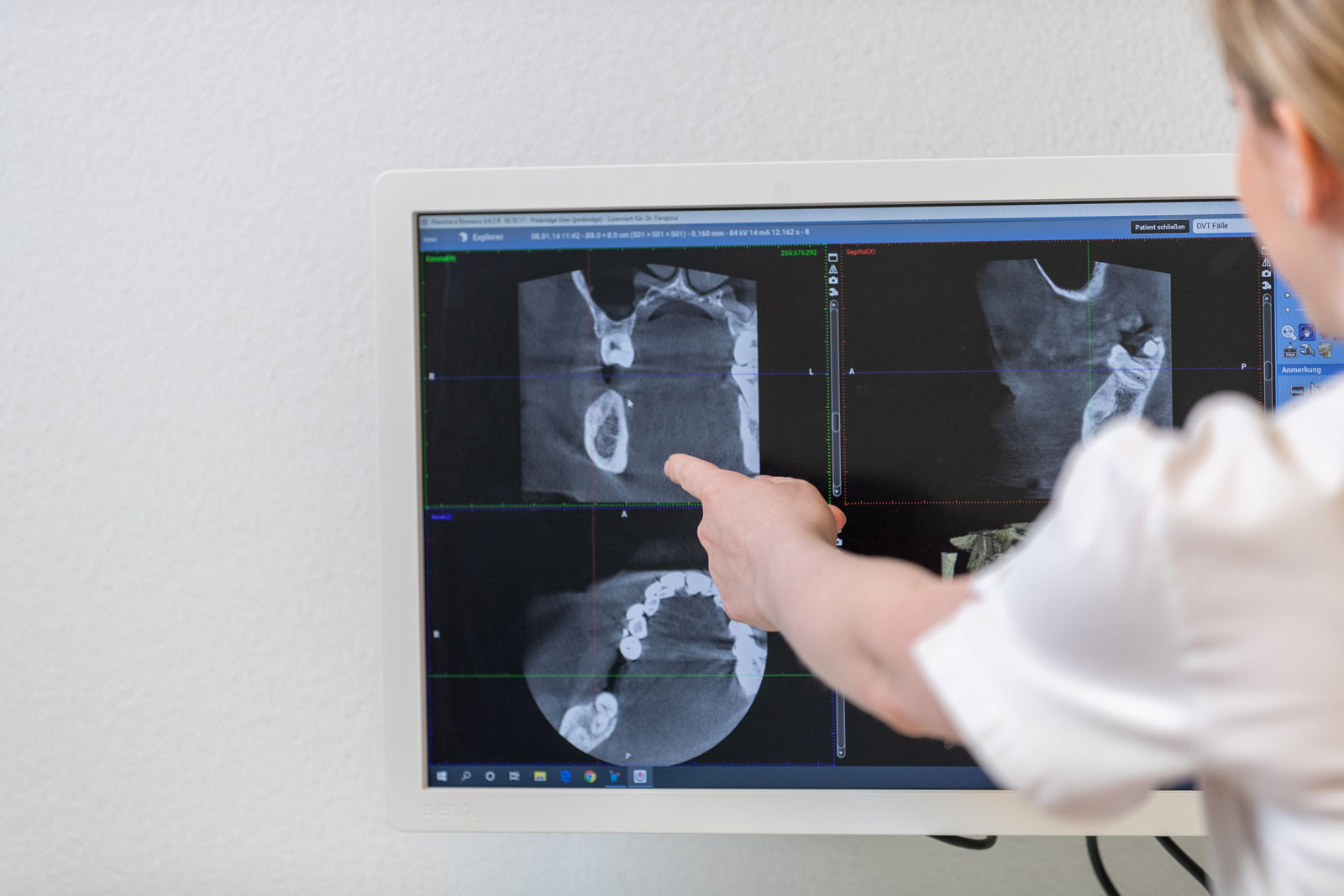 Zahnärztin führt die Weisheitszahnentfernung schonend und schmerzarm durch.