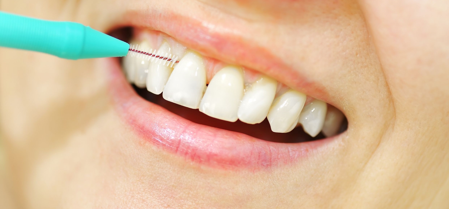 Gefahrenzone Zahnzwischenraum: So können Sie die Zwischenräume gründlich reinigen