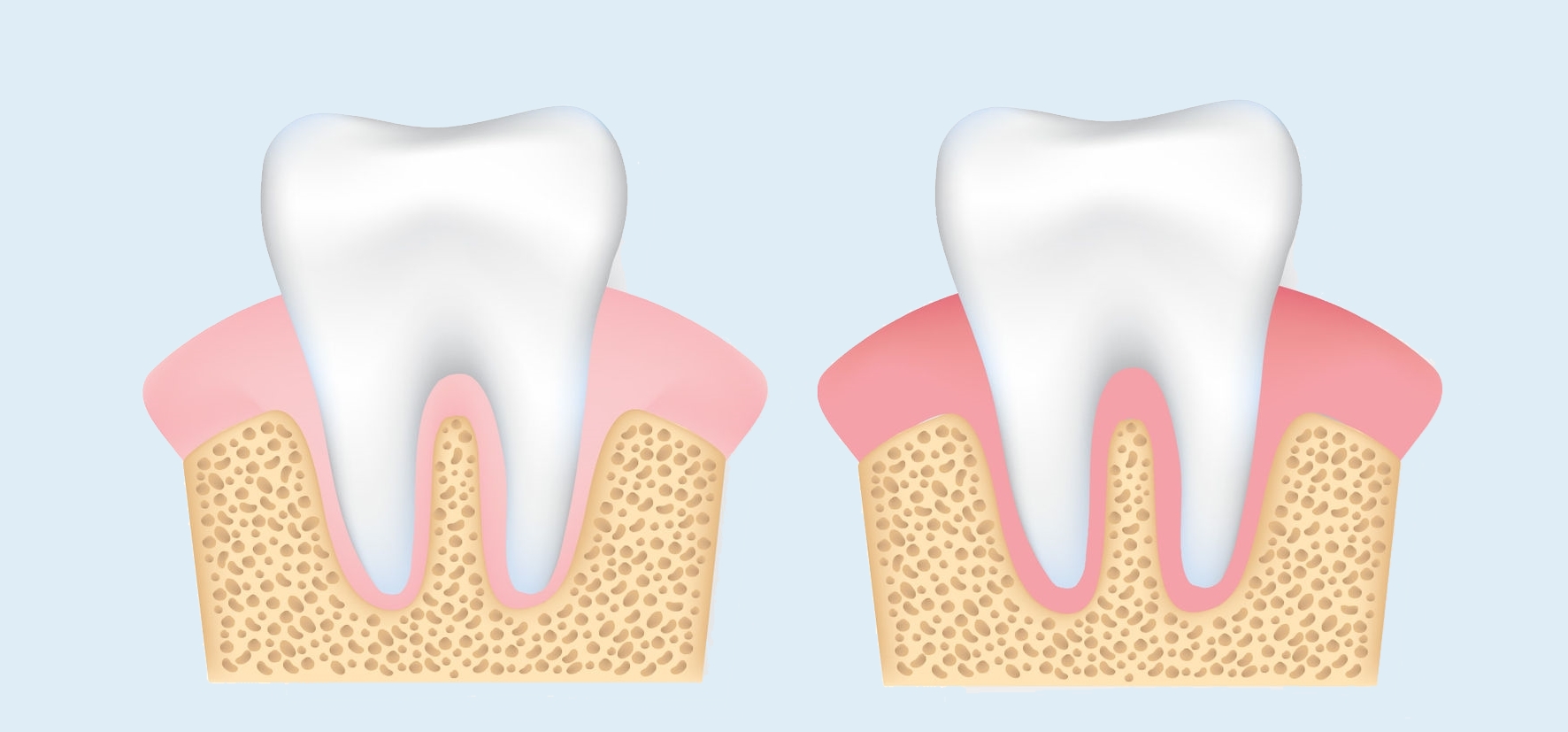 Zahnfleischentzündung: das unterschätzte Gesundheitsrisiko