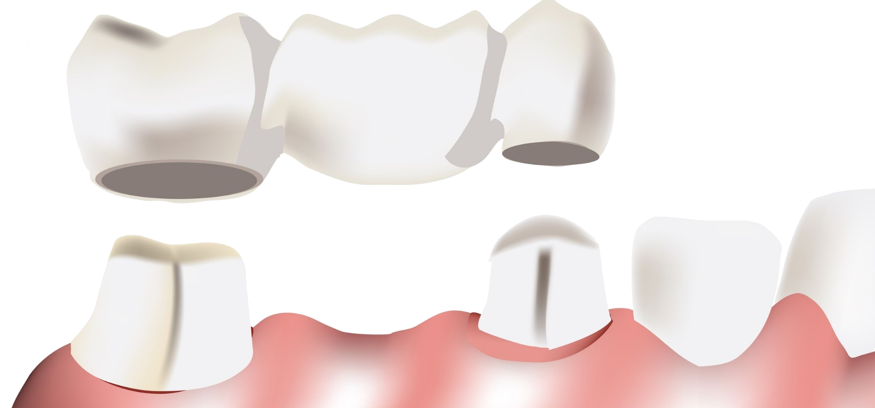Zahnersatz mit einer Zahnbrücke