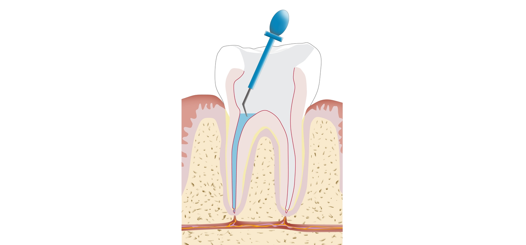 Mit einer Wurzelbehandlung kann der eigene Zahn gerettet werden.