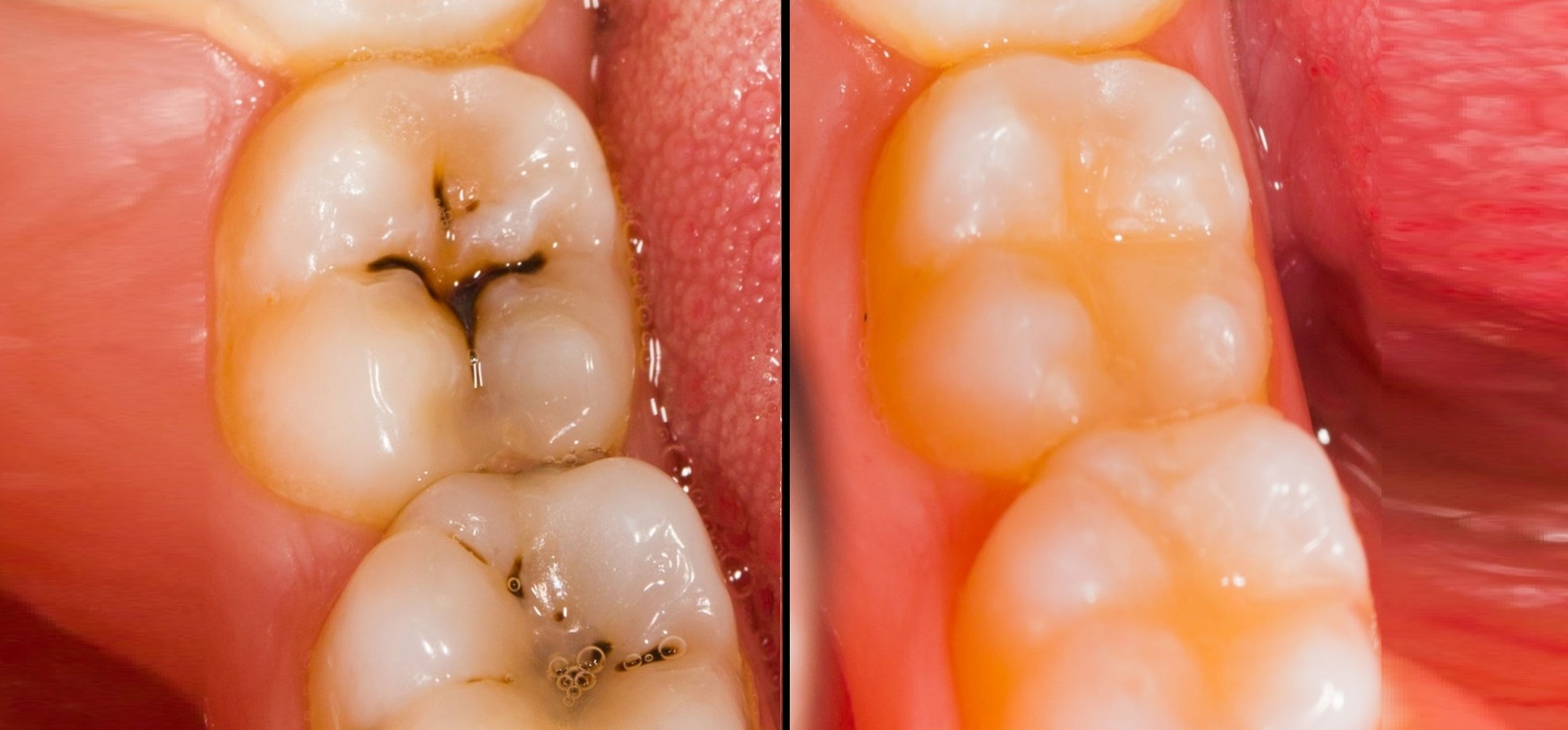 Zahnfüllungen – für strahlendes Lächeln und festen Biss