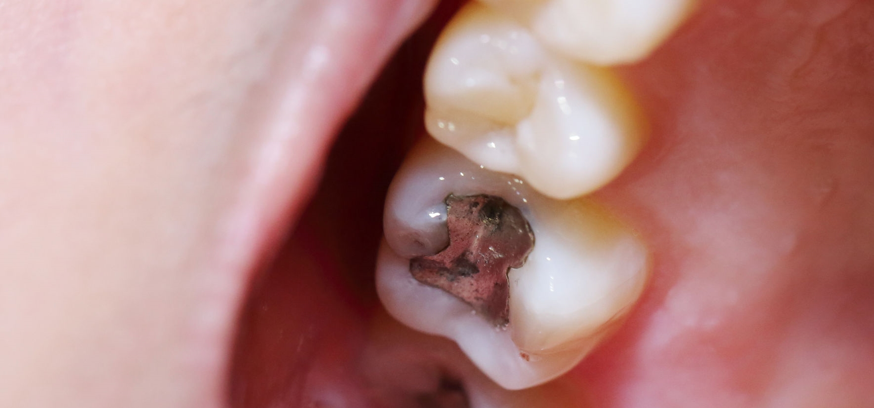 Amalgam: Gesunde und schöne Zähne durch Amalgamentfernung