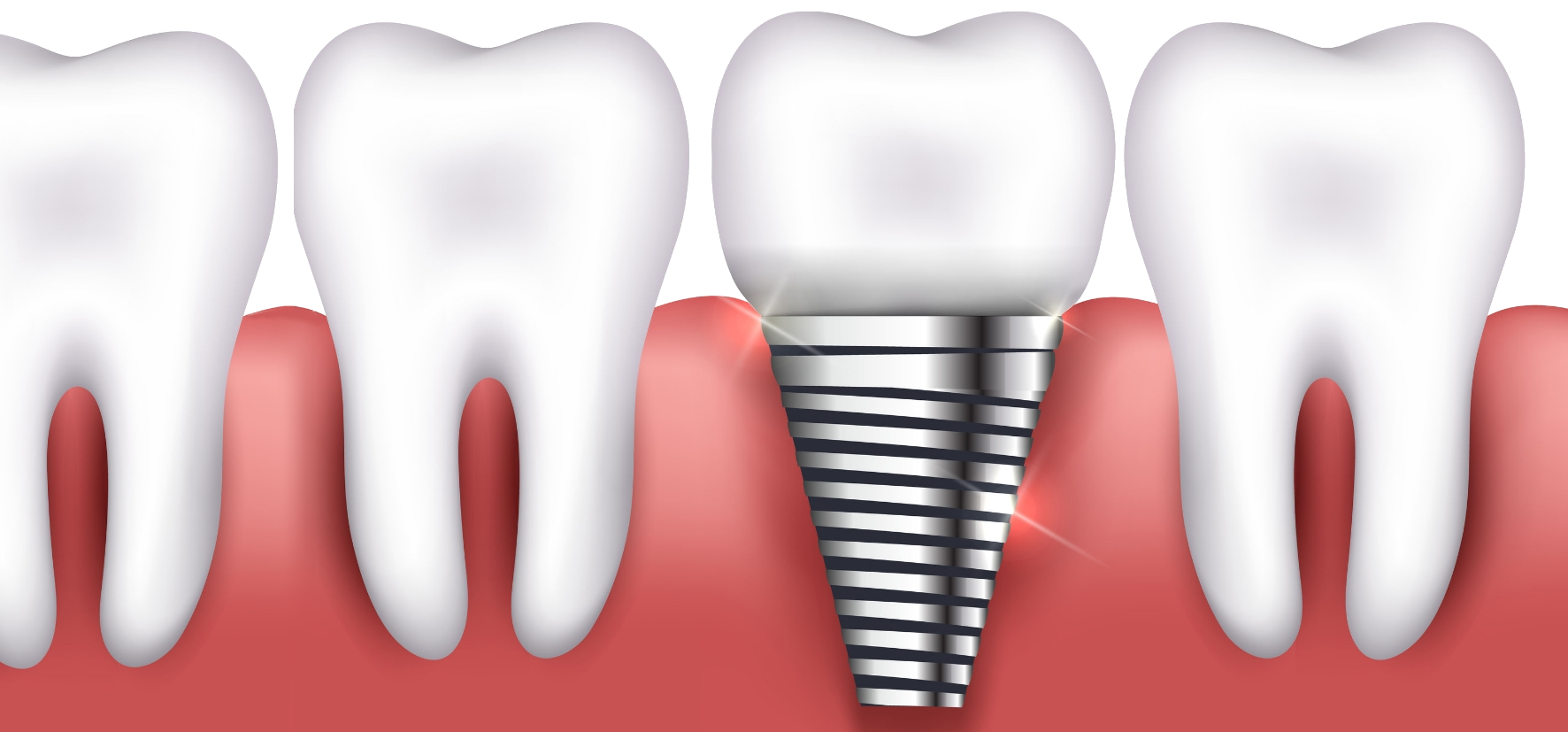 Zahnimplantate schliessen Zahnlücken mit perfekter Optik und Funktion