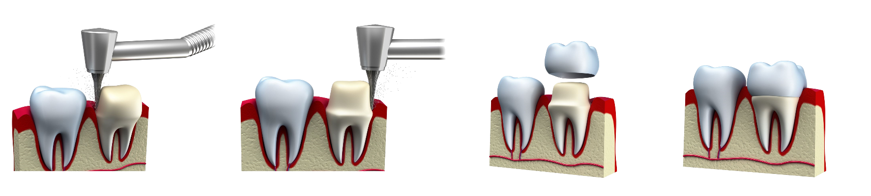 Zahnkrone Verlauf der Behandlung