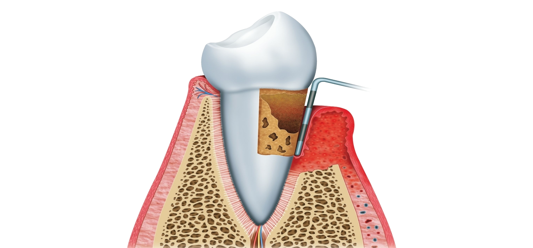 Schnelles Handeln bei Zahnfleisch-Rückgang/-Schwund