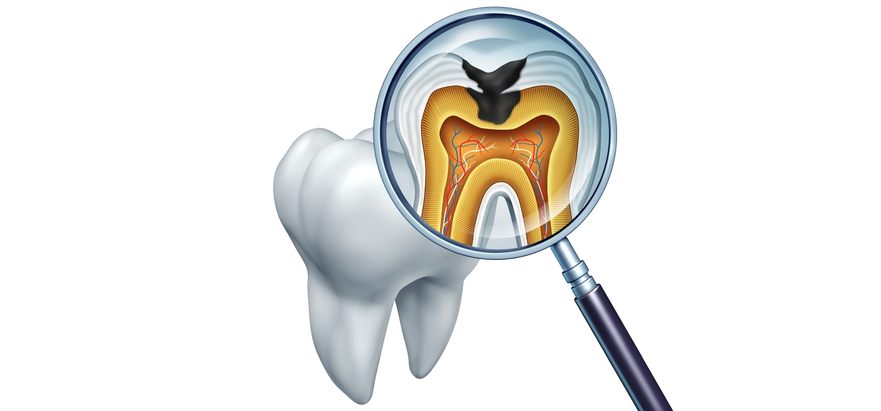 Karies sieht so aus. Karies muss schnell behandelt werden, um eine Zerstörung des Zahns zu verhindern.