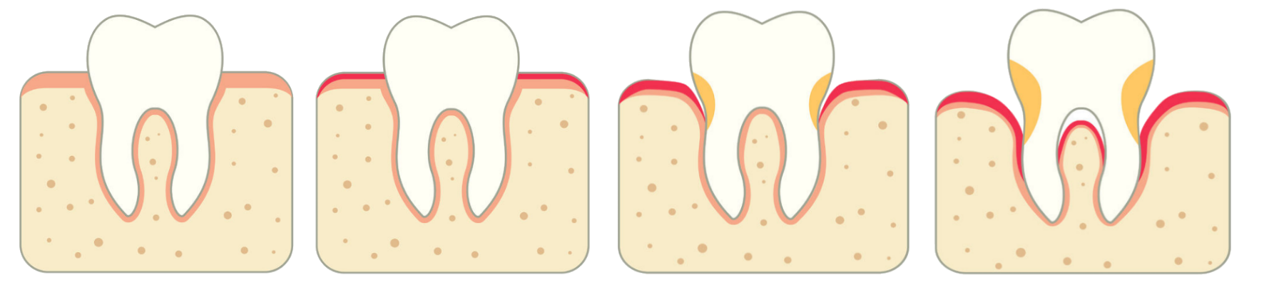Parodontitis Verlauf der Krankheit