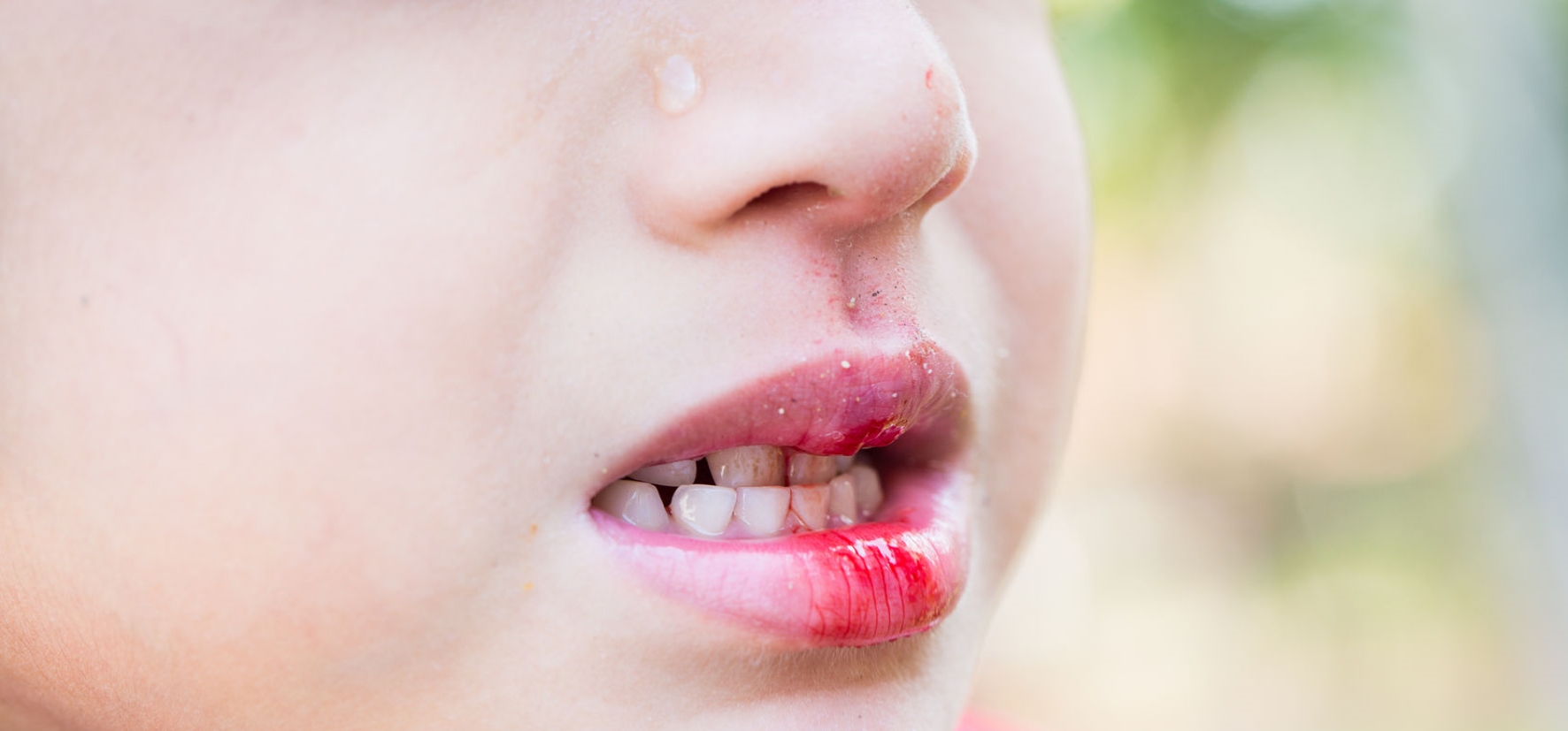 Zahnunfall bzw. Zahn herausgeschlagen