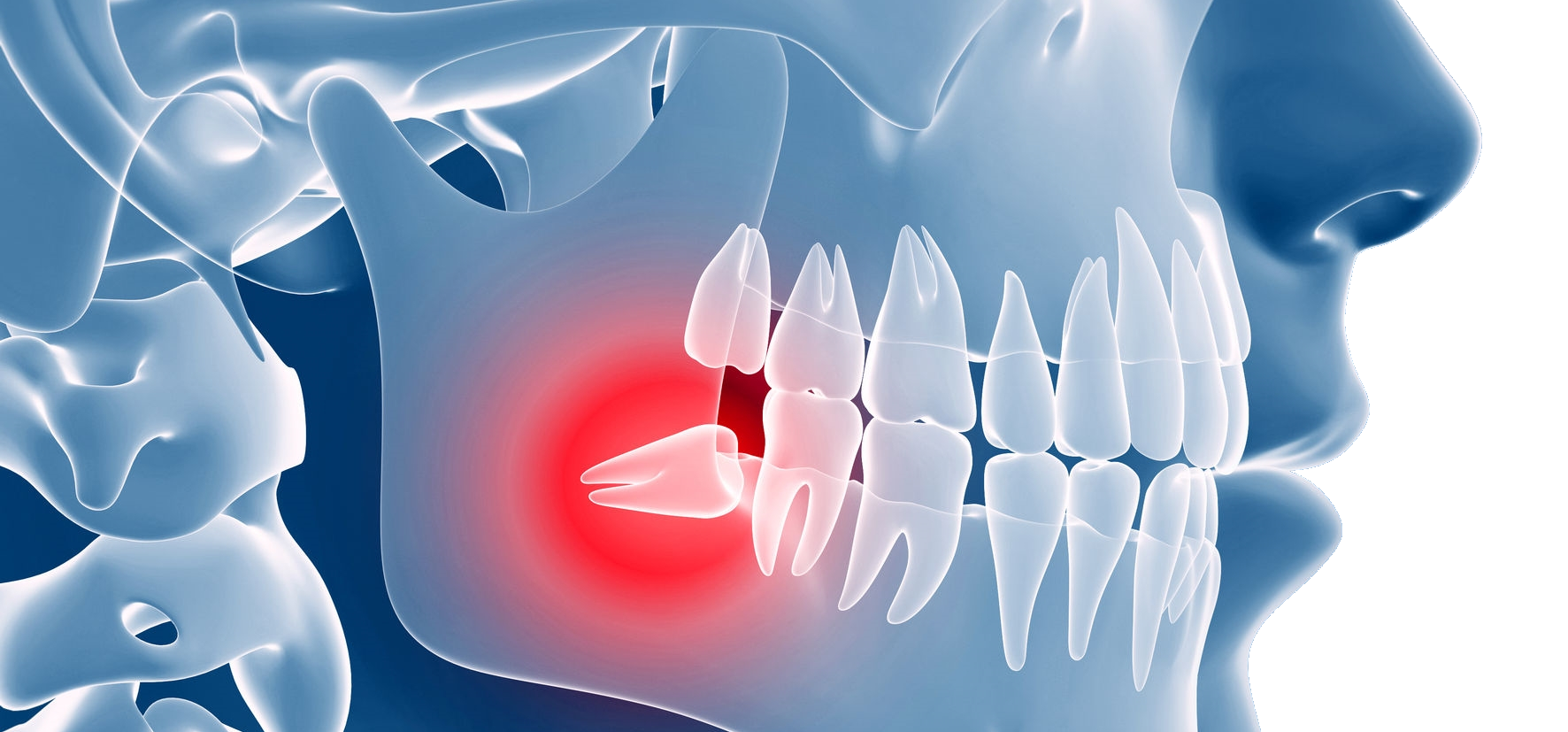 Weisheitszahn: wann eine Entfernung oft sinnvoll ist