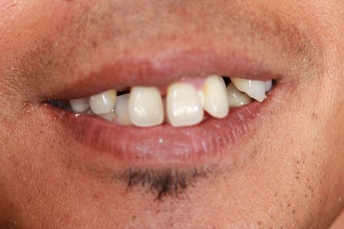 before and after: Implants