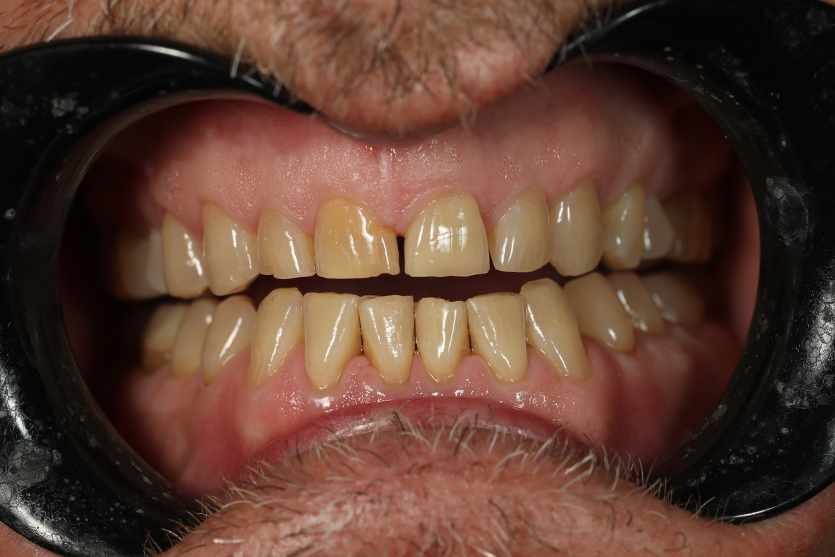 Before & After: Minimal Prep Veneers