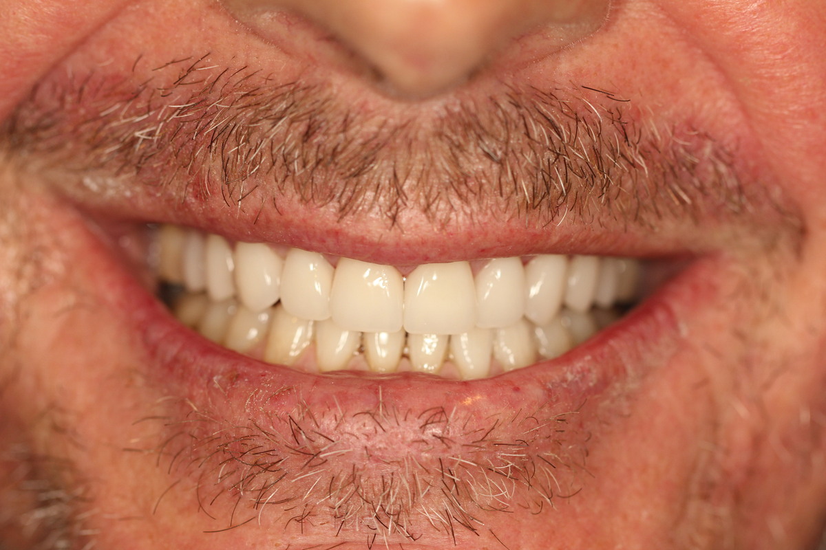 Before & After: Minimal Prep Veneers