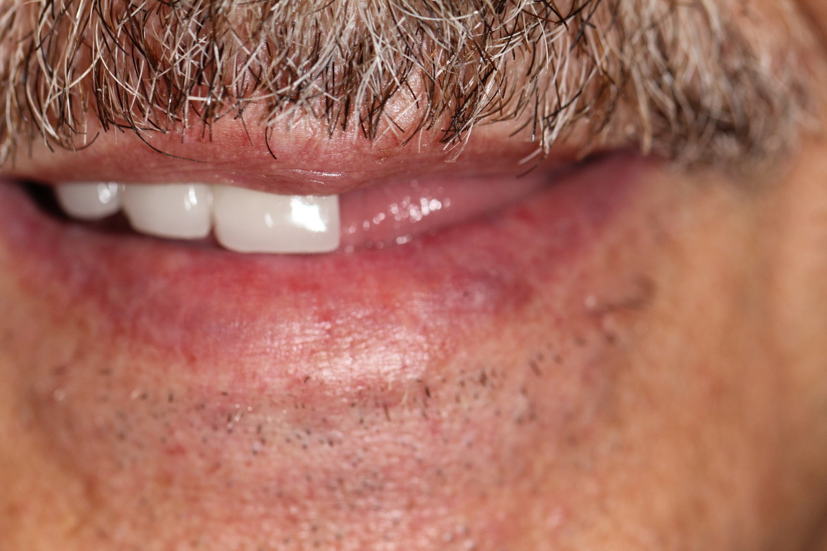 Before & After: Minimal Prep Crowns & Bridges Full Mouth