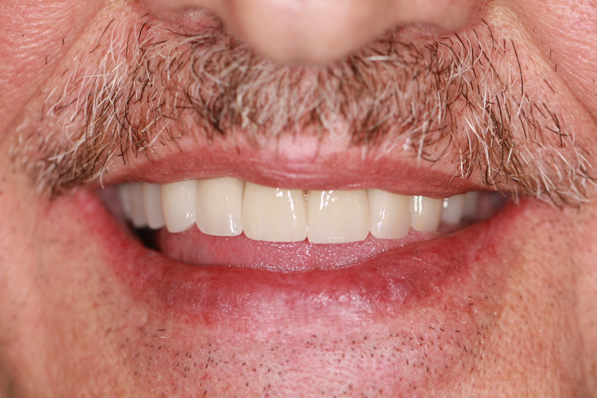 Before & After: Minimal Prep Crowns & Bridges Full Mouth