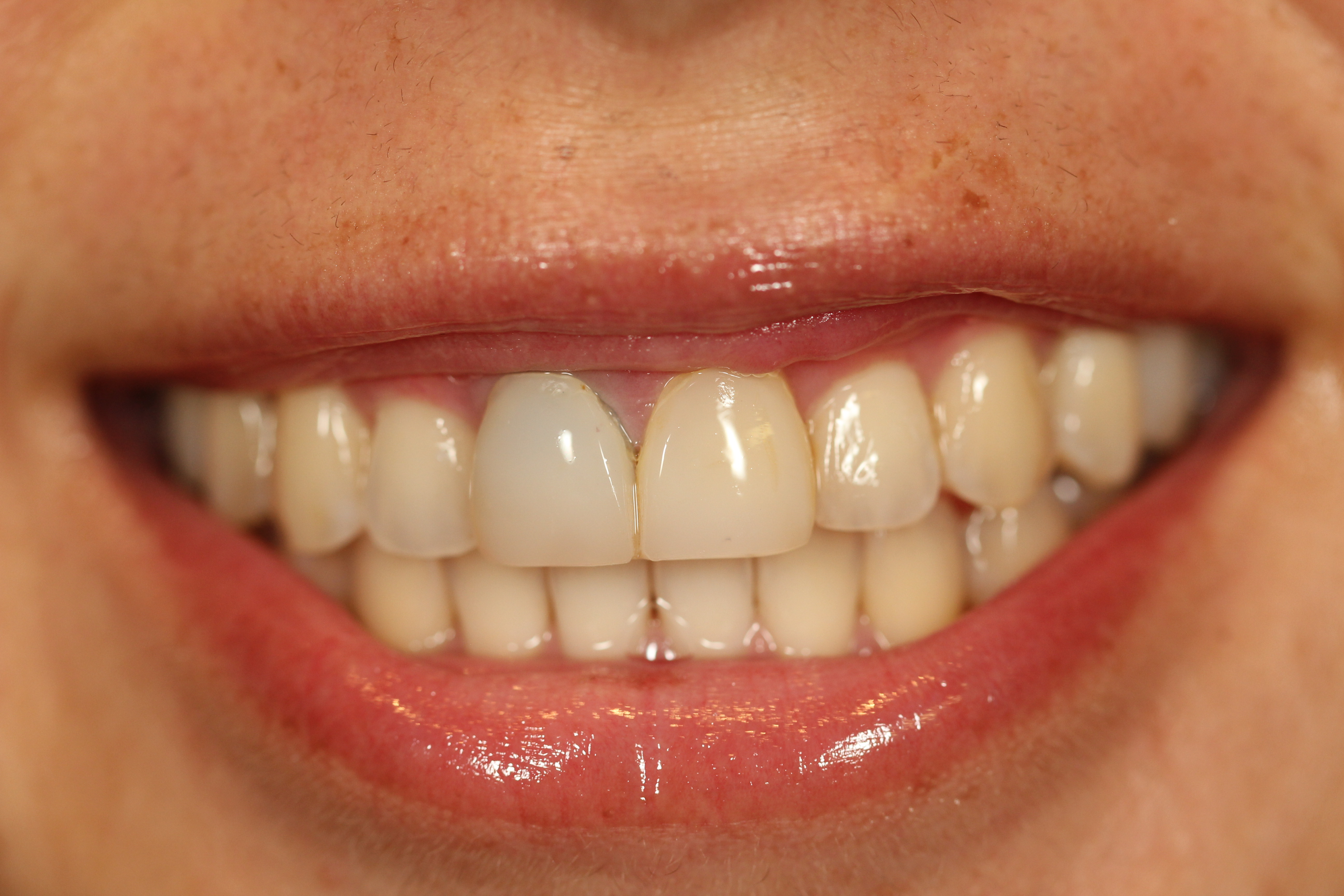 Before & After: Correction to Dental Veneers 