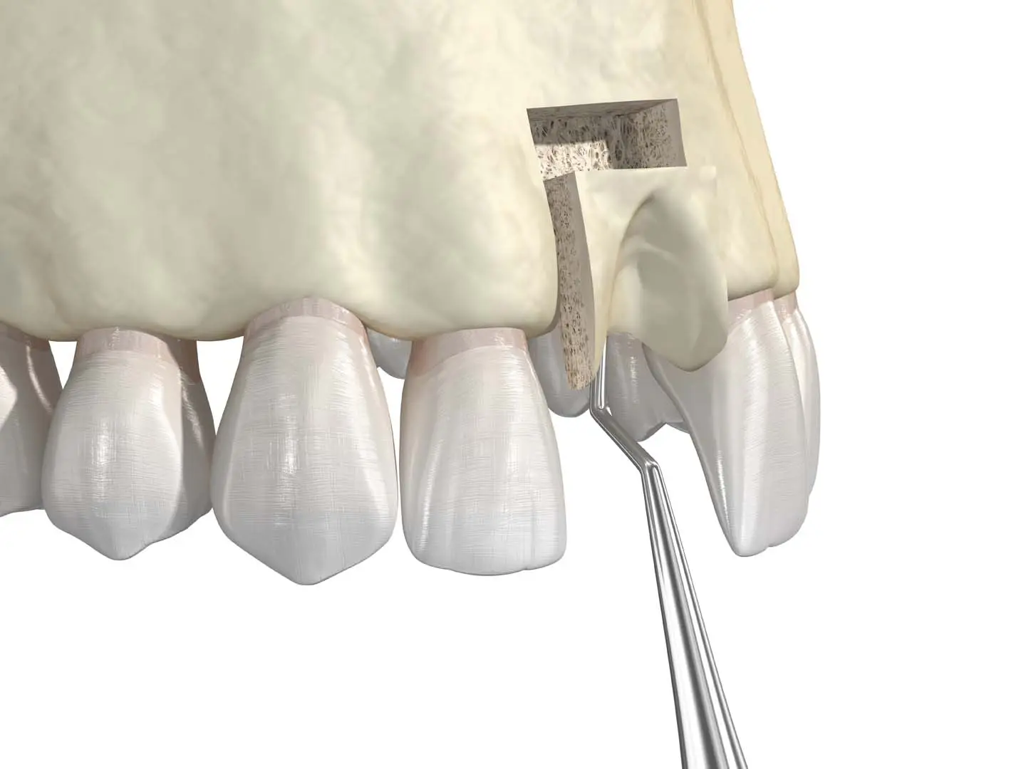 Wisdom Teeth Removal