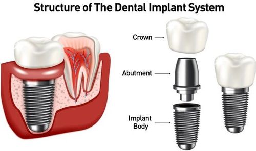 Dental implants image showing the way it screws into the root - an infographic by Anderson Dental Professionals, a top provider of dental implants in Crown Point IN.