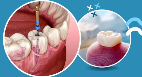 Image depicting the step-by-step process of a root canal procedure performed by a dentist: initial x-ray to locate the infection, anesthesia administration for patient comfort, drilling an access hole into the tooth, cleaning out the infected pulp from the tooth's canal, filling and sealing the canal with gutta-percha, and finally restoring the tooth with a crown for strength and durability.