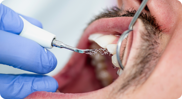 What Does a Dentist Look for During an Oral Cancer Screening?