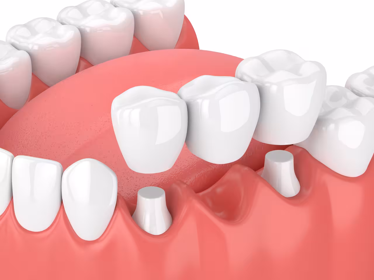 Dental Bridge vs. Implant: Which Is Right for Missing Teeth?