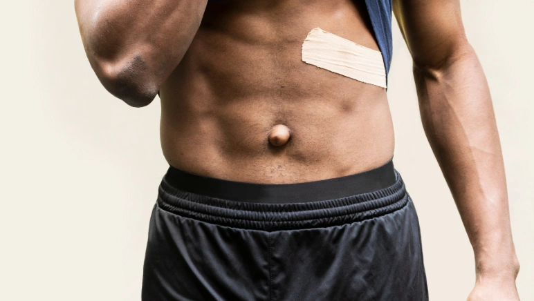 Bulge near surgical scar indicating possible incisional hernia