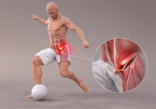 3D illustration of a man about to kick a soccer ball with a highlighted sports hernia injury in the groin area showing inflamed muscle tissue.