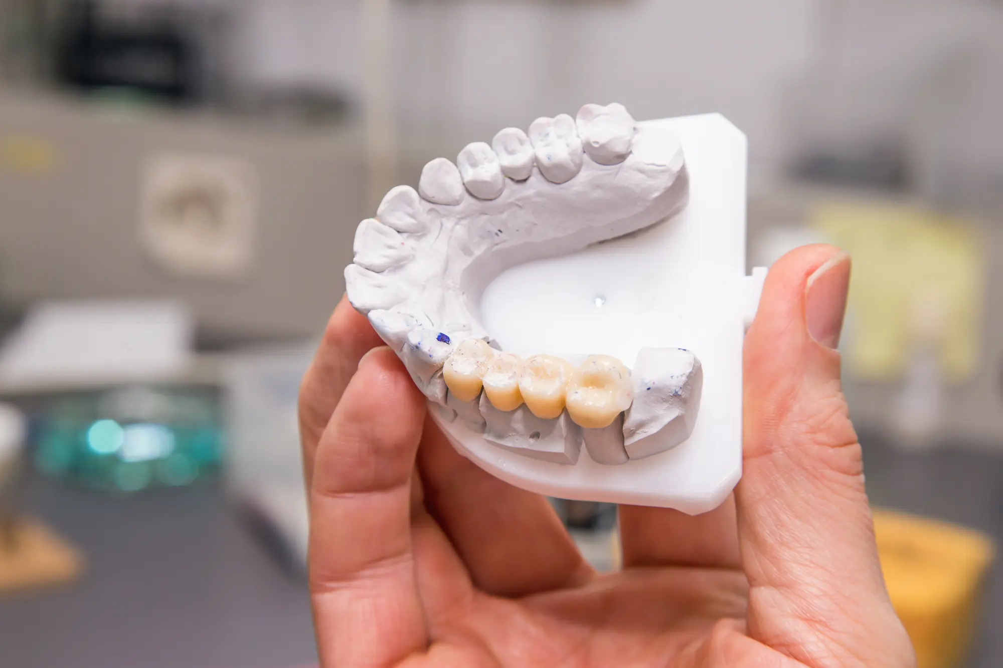 Implant-Supported Bridges