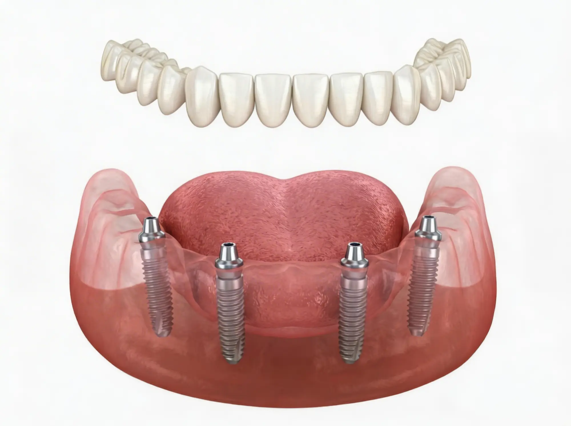 All-on-4 Dental Implants