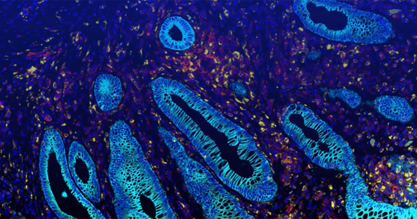 MOSAIC surpasses 1,000 patients across 7 cancers and 6 data modalities, capturing tumor complexity at scale.