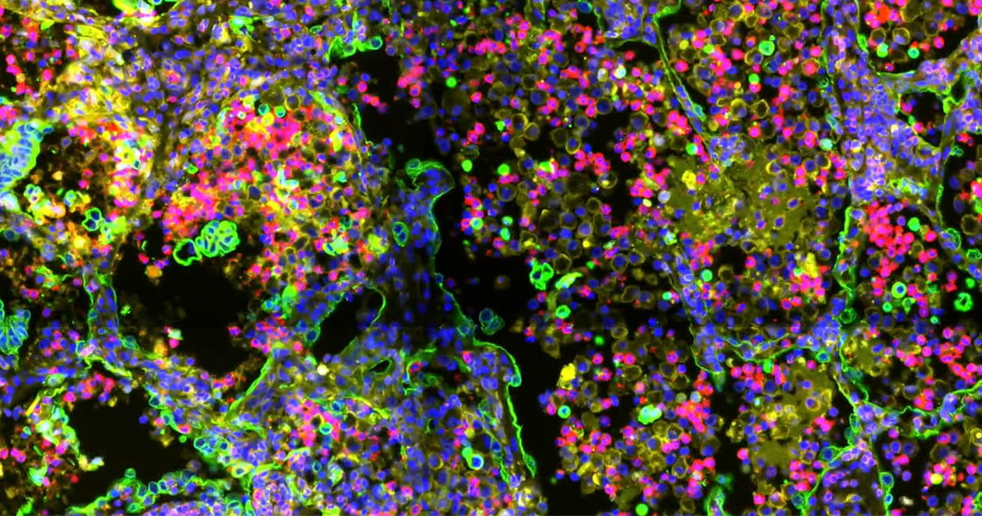 A study that aims at building the largest spatial and multiomics dataset in oncology.