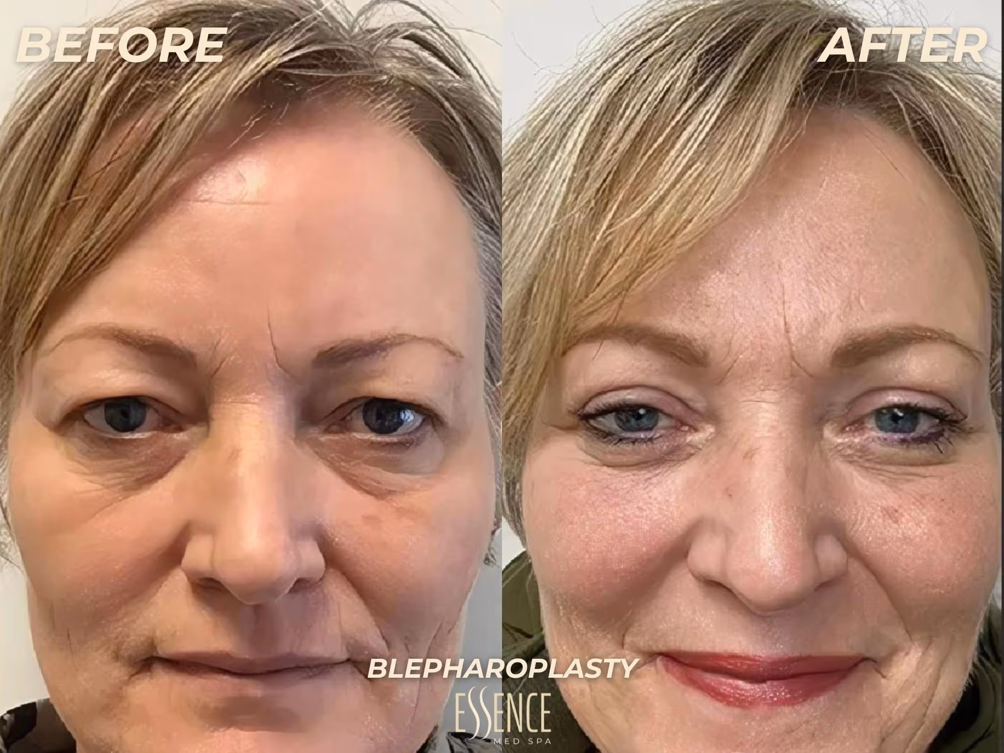 dermal fillers image