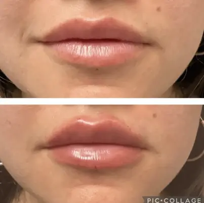 Before and after lip filler treatment showing fuller lips
