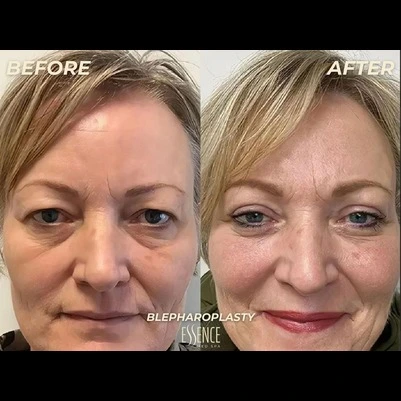 Before and after blepharoplasty results on a woman's face
