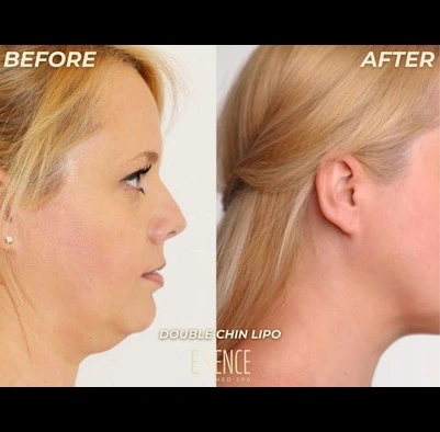 Before and after double chin showing a slimmer jawline on a woman