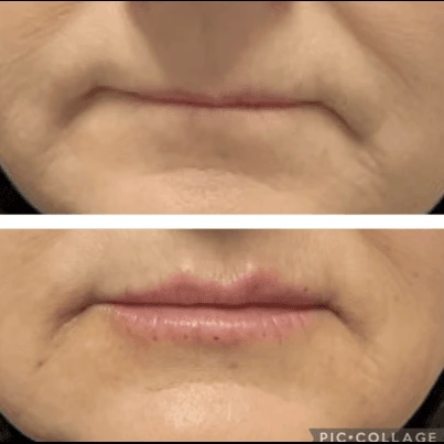 Before and after lip filler treatment