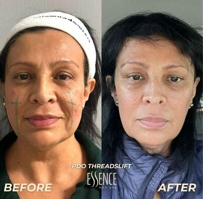 Before and After results on a woman’s face.