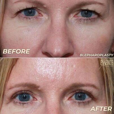 Before and after results and a refreshed eye appearance.