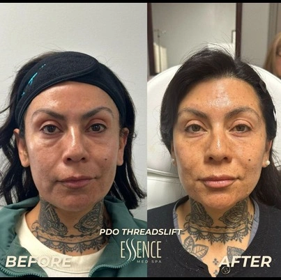 Before and after PDO thread lift treatment on a woman's face.