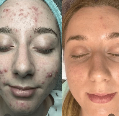 Before and after acne treatment showing clearer, smoother skin on a woman’s face.
