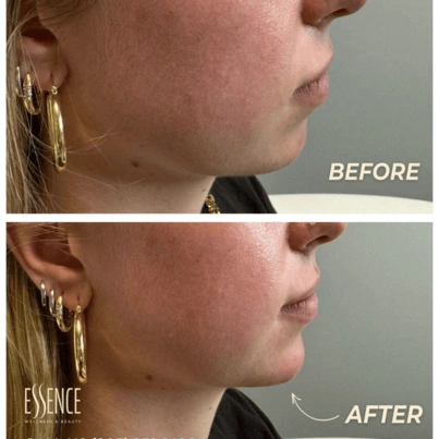 Side-by-side before and after image showing jawline and chin enhancement results