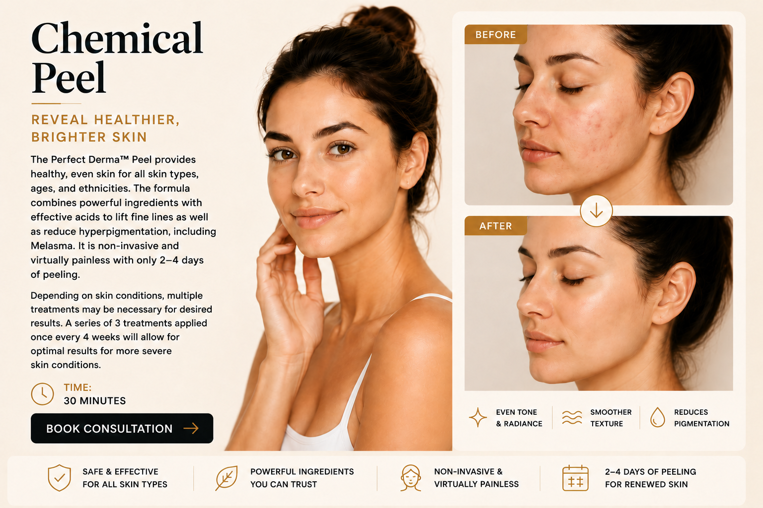 Chemical Peel