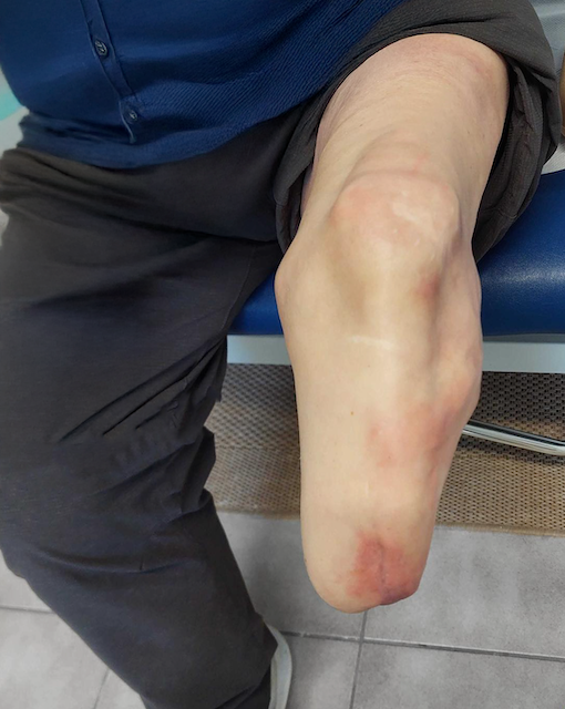 Residual limb volume tracking