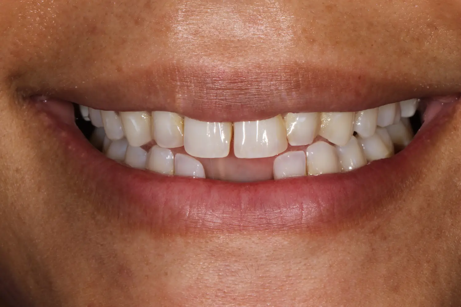 before and after treatment