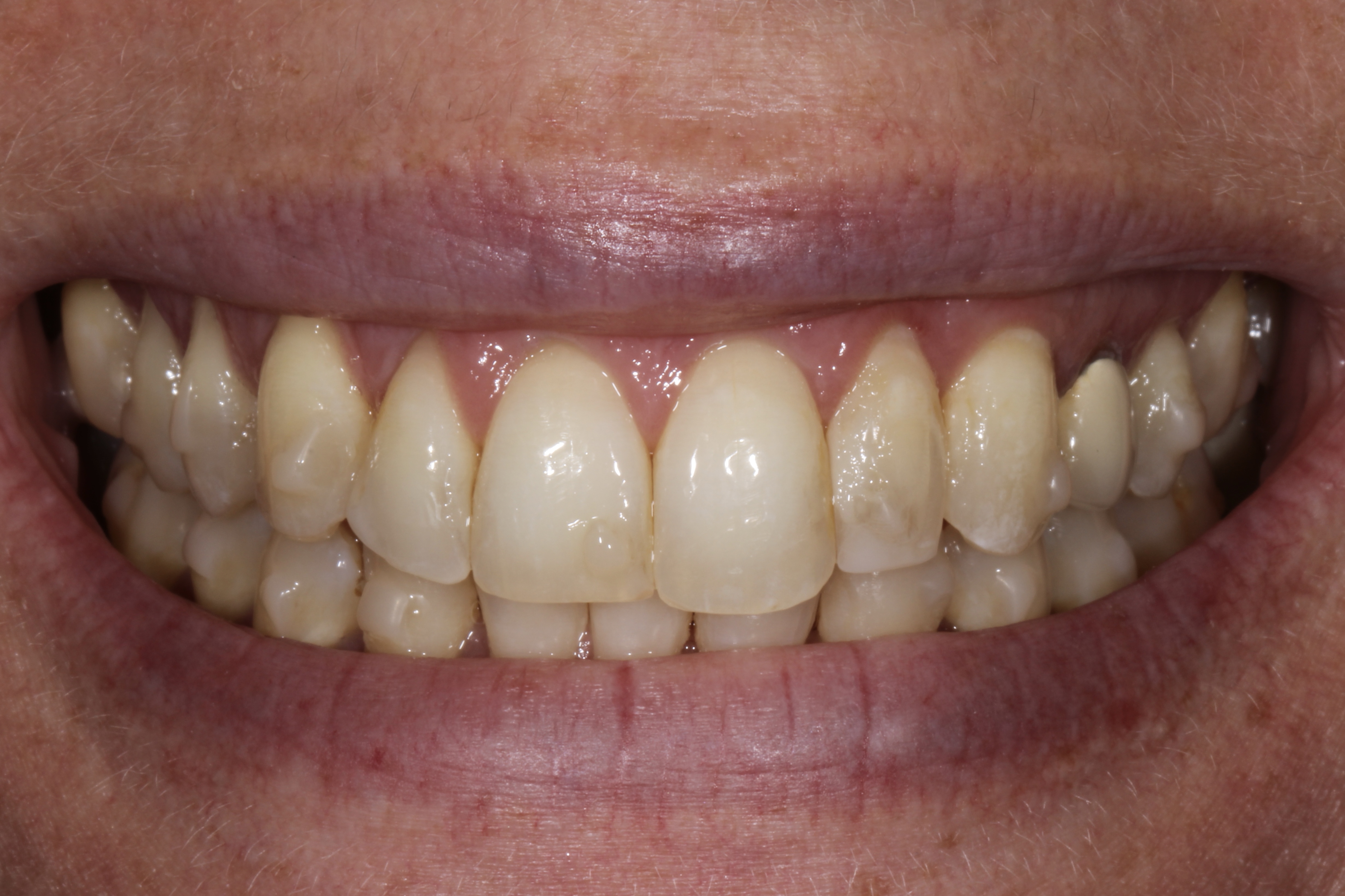 before and after treatment