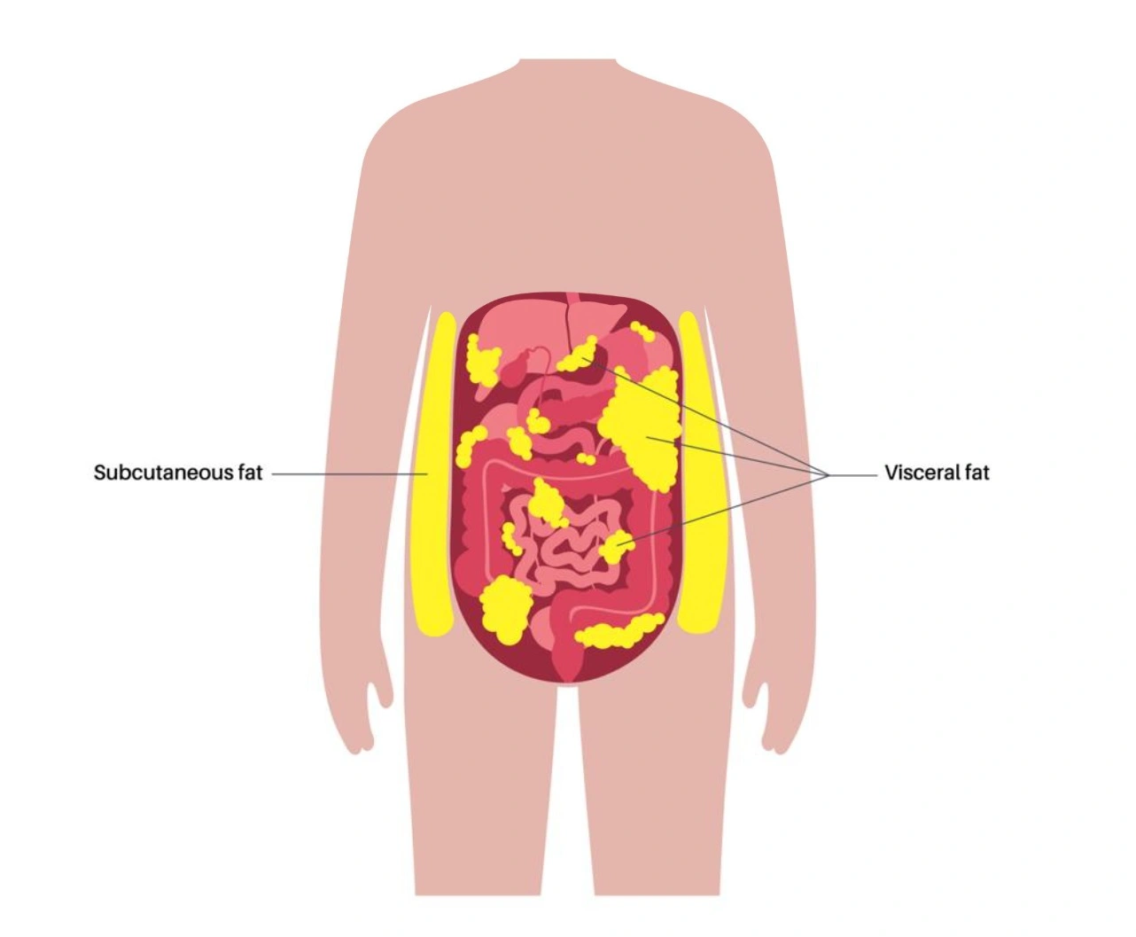 Visceral Fat vs. Subcutaneous Fat