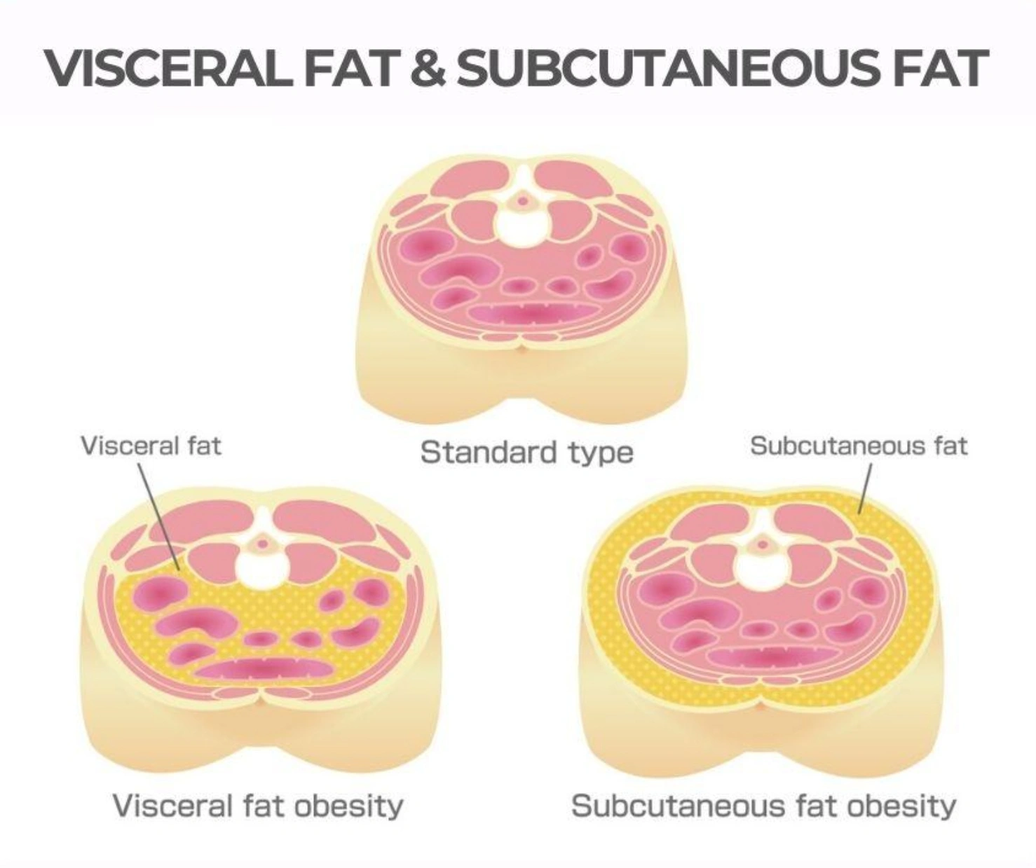 Visceral Fat vs. Subcutaneous Fat Obesity