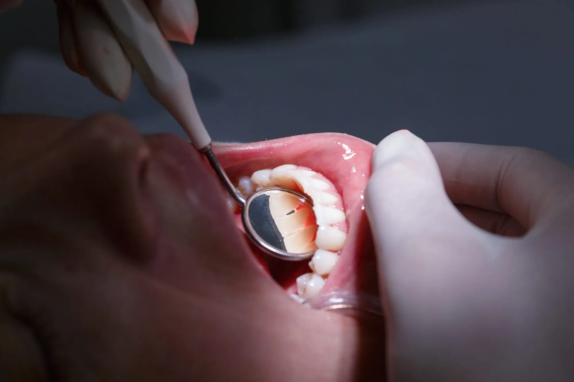 best dentist murfreesboro tn performs scaling and root planing