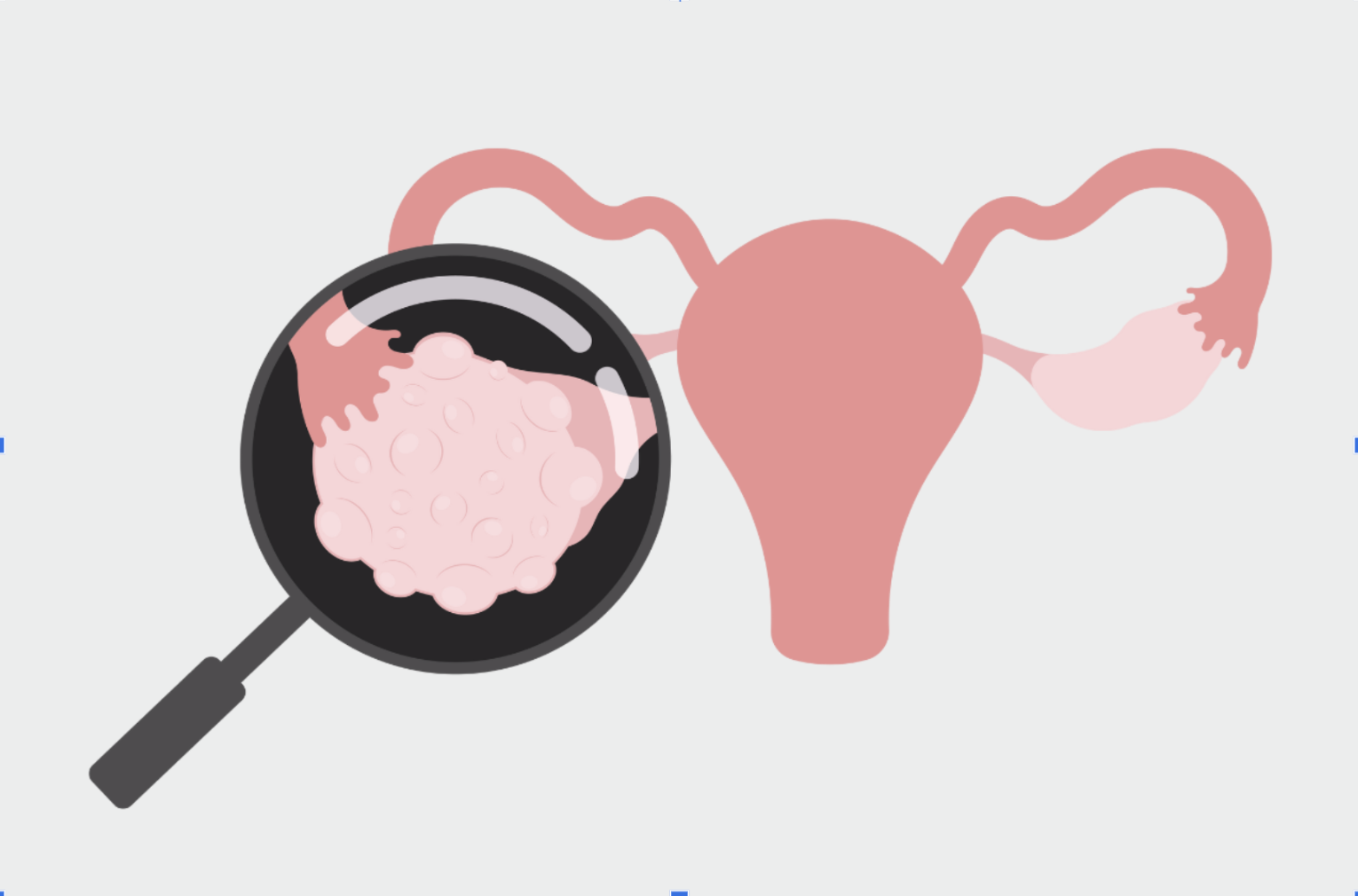 How can Different Cysts Can Affect Your Egg Freezing Cycle